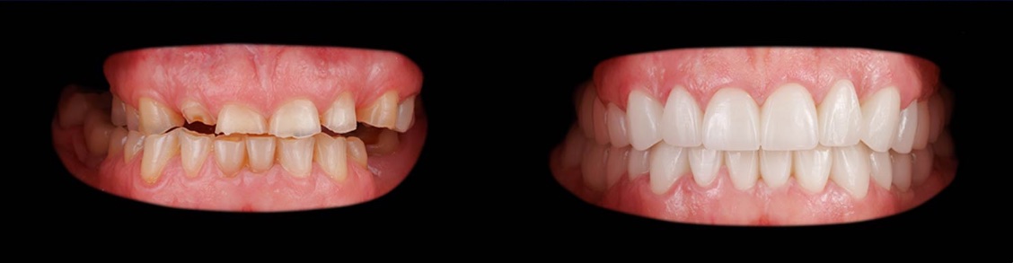 Prima del trattamento: denti usurati, scheggiati e irregolari