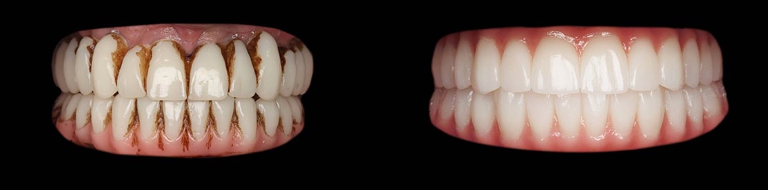 Prima: denti molto macchiati. Dopo: riabilitazione dell'arcata completa