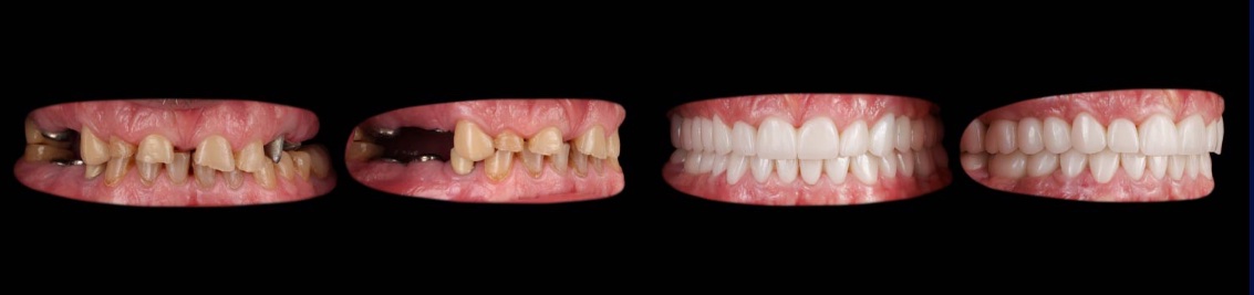 Prima: denti mancanti e danneggiati, due viste. Dopo: riabilitazione completa, due viste